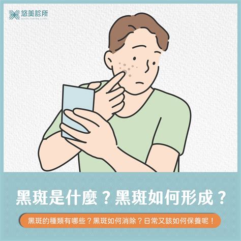 黑斑原因|如何去除黑斑？雷射治療與預防方法的建議，以及黑斑。